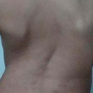 强直性脊柱炎的症状图4