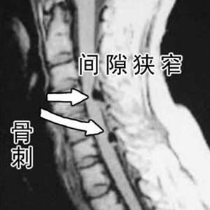 颈椎病x光片4