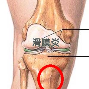 滑膜炎图片4