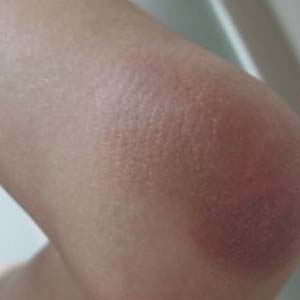 滑膜炎的症状图片5