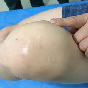 膝盖滑膜炎图片4