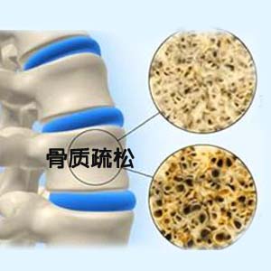骨质疏松图片