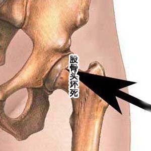 股骨头坏死图片2