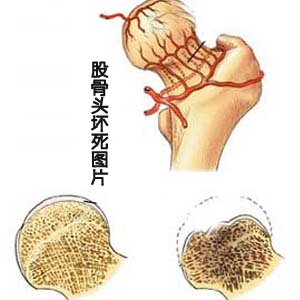 股骨头坏死图片5