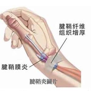 腱鞘炎图片4