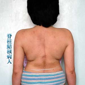 脊柱结核病人1