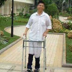 脊髓炎图片5