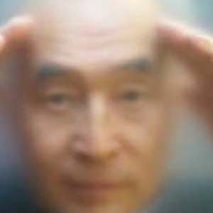 白内障早期图片3