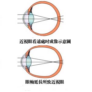 近视眼成像示意图6