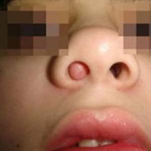 儿童鼻息肉图片