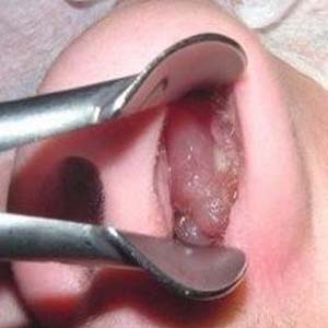 儿童鼻息肉图片6