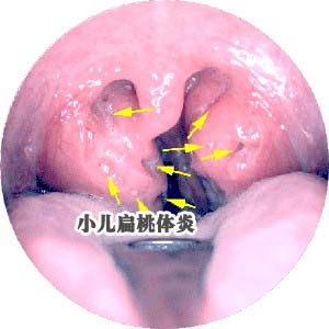 小儿扁桃体炎图片3