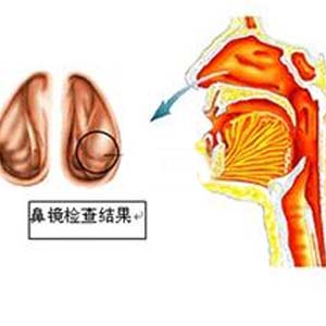 慢性鼻炎解剖图8