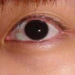 青光眼的早期症状图片4