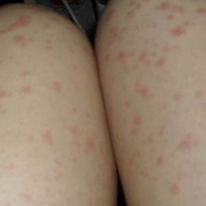 女性荨麻疹症状图片6