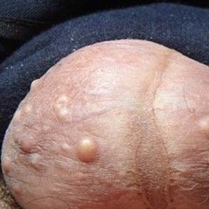 男性湿疹症状8