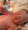 婴儿手握避孕环出生 为何“带环受孕”